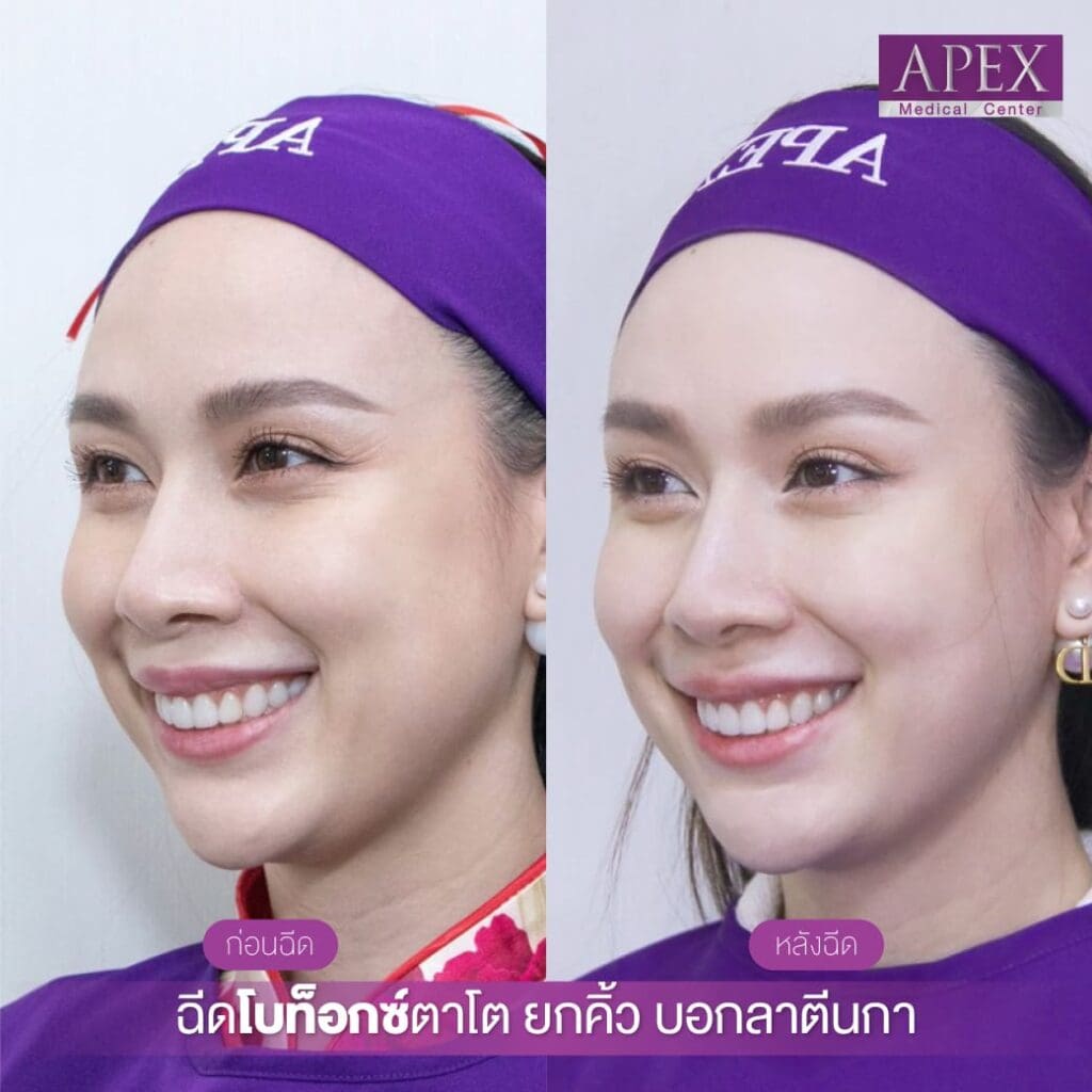 Shallow eye wrinkles