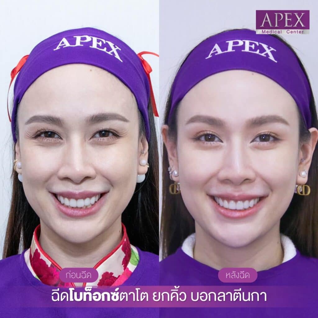 Shallow eye wrinkles