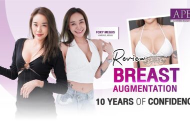 Breast Augmentation Journey: 10 Years of Confidence