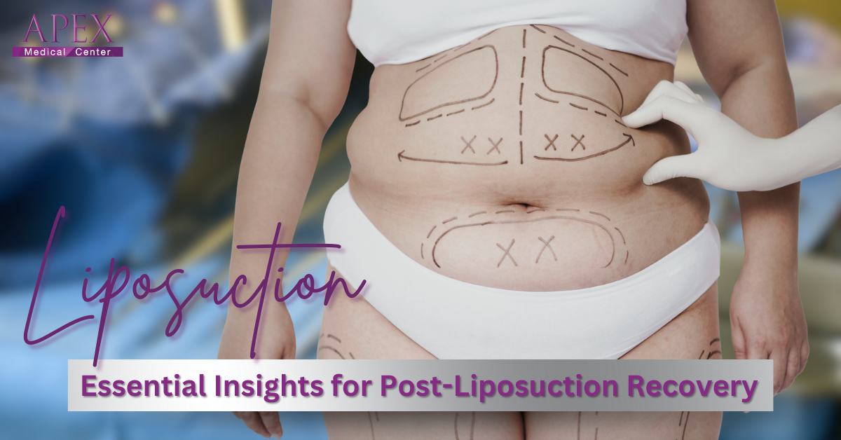 Essential Insights for Post-Liposuction Recovery